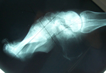 Don, Pre-op thumbnail of an X-ray, Limb Lengthening, Foot Deformity Correction, Charcot-Marie-Tooth Disease 