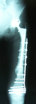 Roberta, Follow up thumbnail of an x-ray, limb lengthening, nonunion repaired, locking plates, bone graft