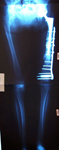 Roberta, Follow up thumbnail of an x-ray, limb lengthening, nonunion repaired, locking plates, bone graft