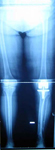 Madeline, Follow up thumbnail of x-ray, Limb Lengthening, deformity correction, gait correction