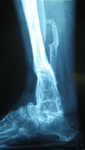 Madeline, Post op thumbnail of an X-ray, Limb Lengthening, ankle fusion, tibial malunion