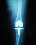 Madeline, Post op thumbnail of an X-ray, Limb Lengthening, total knee replacement