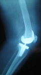 Madeline, Post op thumbnail of an X-ray, Limb Lengthening, total knee replacement