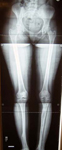 Natalie, Post Op thumbnail of an x-ray, Limb Lengthening, equal leg lengths, healed tibia