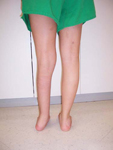Natalie, Pre Op thumbnail Image, Limb Lengthening, Congenital Pseudoarthrosis of the Tibia