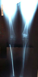 Natalie, Pre Op thumbnail of an x-ray , Limb Lengthening, deformity, nonunion, and shortening of the tibia above the ankle