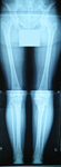 Ingrid, Follow-up thumbnail of an x-ray, Limb Lengthening, more balanced, better knee function