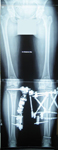Ingrid, Post-op thumbnail of an x-ray, Limb Lengthening, Bilateral tibial osteotomies, TSF used on left side, EBI monolateral frame on right side