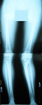 Ingrid, Pre-op thumbnail of an x-ray, Limb Lengthening, Bilateral Leg Windswept Deformity