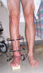 Graham, Post-op thumbnail Image, Limb Lengthening, ankle reconstruction with fusion and circular external fixator, limb lengthening 4cm with ring and TSF