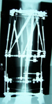 Graham, Post-op thumbnail of an x-ray Image, Limb Lengthening, ankle reconstruction with fusion and circular external fixator, limb lengthening 4cm with ring and TSF