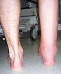 Graham, Pre-op thumbnail Image, Rock Climbing Accident, Ankle Fusion, Tibia Lengthening, Limb Lengthening