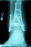 Graham, Pre-op thumbnail of an x-ray Image, Rock Climbing Accident, Ankle Fusion, Tibia Lengthening, Limb Lengthening