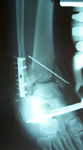 Graham, Pre-op thumbnail of an x-ray Image, Rock Climbing Accident, Ankle Fusion, Tibia Lengthening, Limb Lengthening