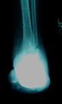 Claire, Follow up thumbnail of  an x-ray Image, Limb Lengthening, Stable plantigrade foot