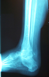 Claire, Follow up thumbnail of an x-ray Image, Limb Lengthening, Stable plantigrade foot