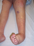 Claire, Pre Op thumbnail Images, Limb Lengthening, foot and ankle deformity, neuropathy