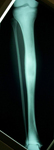 Ian, Pre Op thumbnail of an x-ray Image, low grade osteosarcoma in his tibia