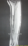 Ian, Pre Op thumbnail of an x-ray Image, low grade osteosarcoma in his tibia