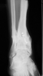 Dino, Post-op thumbnail of an x-ray Image, Limb Lengthening, deformity correction and distraction