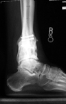 Dino, Post-op thumbnail of an x-ray Image, Limb Lengthening, deformity correction and distraction