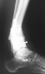 Dino, Pre-op thumbnail of an x-ray Image, Limb Lengthening, tibia deformity