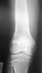 Alex, Follow up thumbnail of an x-ray, Limb Lengthening, pediatrics, leg lengthened 