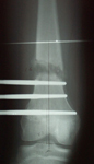 Alex, Post-op thumbnail of an x-ray, Limb Lengthening, pediatrics, femoral osteotomy, EBI monolateral lengthening frame