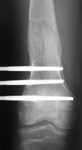 Alex, Post-op thumbnail of an x-ray, Limb Lengthening, pediatrics, femoral osteotomy, EBI monolateral lengthening frame