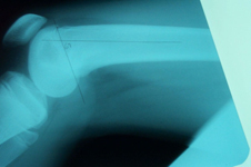 Alex, Pre-op thumbnail of an x-ray, Limb Lengthening, femur lengthening, pediatrics, distal femur growth plate