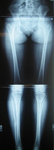 Zaida, Follow up thumbnail of an x-ray Image, Limb Lengthening, straightened legs, no knee pain