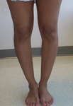 Zaida, Pre Op thumbnail Image, Limb Lengthening, Bowleg deformity, Arthritis Prevention
