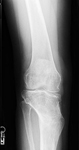 Renee, Follow up thumbnail of an x-ray Image, Limb Lengthening, Knee and back pain have improved, leg straightened