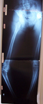 Renee, Pre-op Thumbnail of an X-ray Image, Limb Lengthening, Blout's Disease
