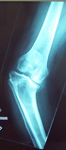 Renee, Pre-op Thumbnail of an X-ray Image, Limb Lengthening, Blout's Disease