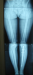 Thumbnail of an x-ray of Kim, follow up image, lengthened leg, knee and back pain have improved, Limb Lengthening