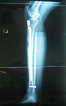 thumbnail of an x-ray of Kim's leg, Post-op image, lengthen tibia, LATN technique, TSF External fixator, Limb Lengthening