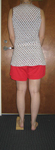 Thumbnail of Kim, Pre-op image, Congenital left leg shortening on inch, Limb Lengthening