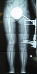 thumbnail, x-ray, post-op, Gabriella, EBI Biomet Pediatric MAC frame, femur osteotomy, Limb Lengthening