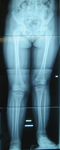 x-ray thumbnail, pre-op, Gabriella, Congenital leg length discrepancy, Limb Lengthening