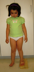 thumbnail pre-op, Gabriella, Congenital leg length discrepancy, Limb Lengthening