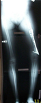 Limb lengthening x-ray Pre-Op, nonunion 7cm shortening and varus deformity