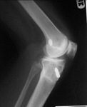 Nicole, Follow up thumbnail of an x-ray, Limb Lengthening, realignment, prevention of pain, arthritis prevention
