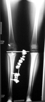 Nicole, Post-op thumbnail of an x-ray, Limb Lengthening, post-traumatic arthritis, osteotomy, proximal tibia, ebi frame