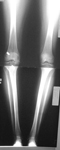 Nicole, Pre-op thumbnail of an x-ray, Limb Lengthening, post-traumatic arthritis, varus deformity, bowleg deformity
