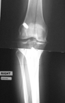 Nicole, Pre-op thumbnail of an x-ray, Limb Lengthening, post-traumatic arthritis, varus deformity, bowleg deformity