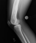 Michaela, follow up photo, Femur lengthening and deformity correction after growth arrest.