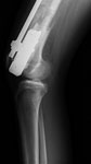 Michaela, postop photo, Femur lengthening and deformity correction after growth arrest.