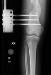 Michaela, postop photo, Femur lengthening and deformity correction after growth arrest.