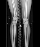 Michaela, preop photo, Femur lengthening and deformity correction after growth arrest.